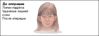 Отопластика (пластика уха) легко исправит косметический дефект.  - <ro>Изображение</ro><ru>Изображение</ru> #1, <ru>Объявление</ru> #20553