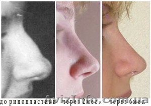 Ринопластика - изменение формы и размера носа.  - <ro>Изображение</ro><ru>Изображение</ru> #1, <ru>Объявление</ru> #8491