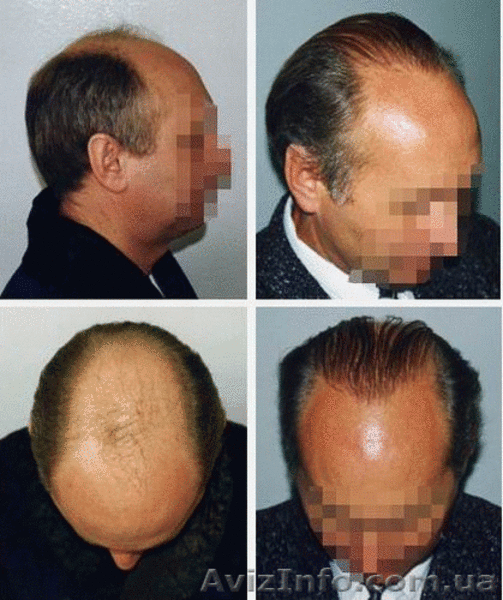 Пересадка волос. Трансплантация собственных волос - <ro>Изображение</ro><ru>Изображение</ru> #2, <ru>Объявление</ru> #8486