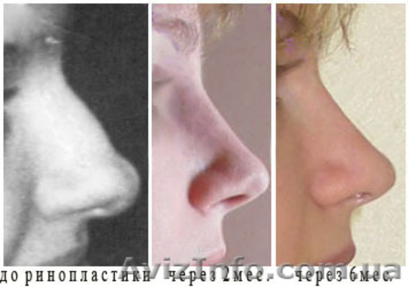 Нос после ринопластики по месяцам фото